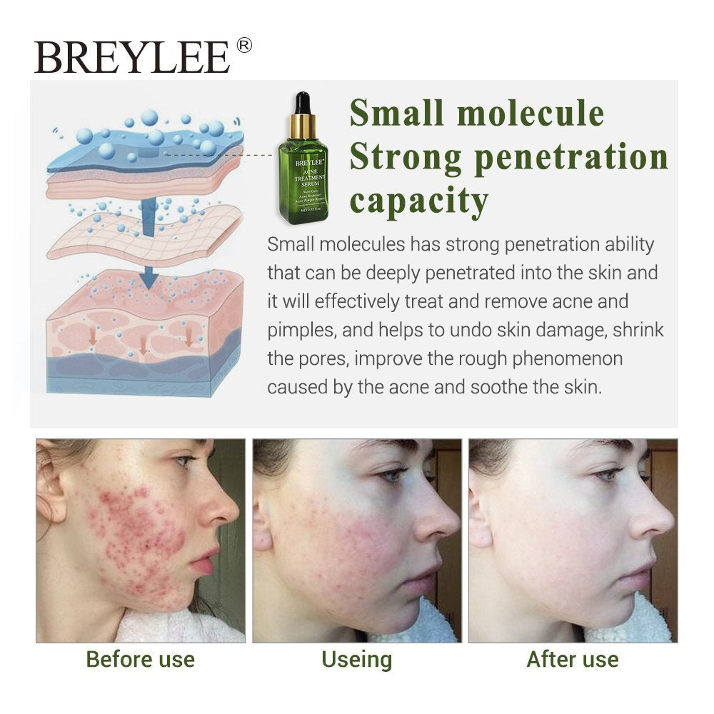BREYLEE Acne Treatment Serum Facial Scar Removal Cream Whitening Repair Skin Care