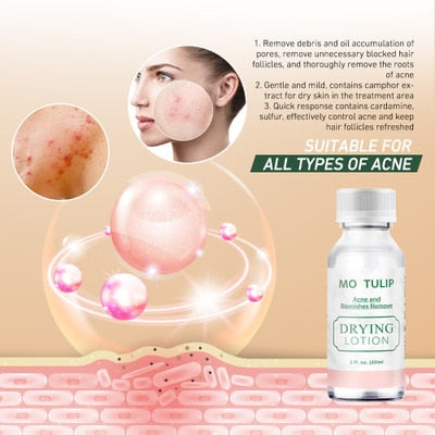 Effective Acne Treatment Lotion